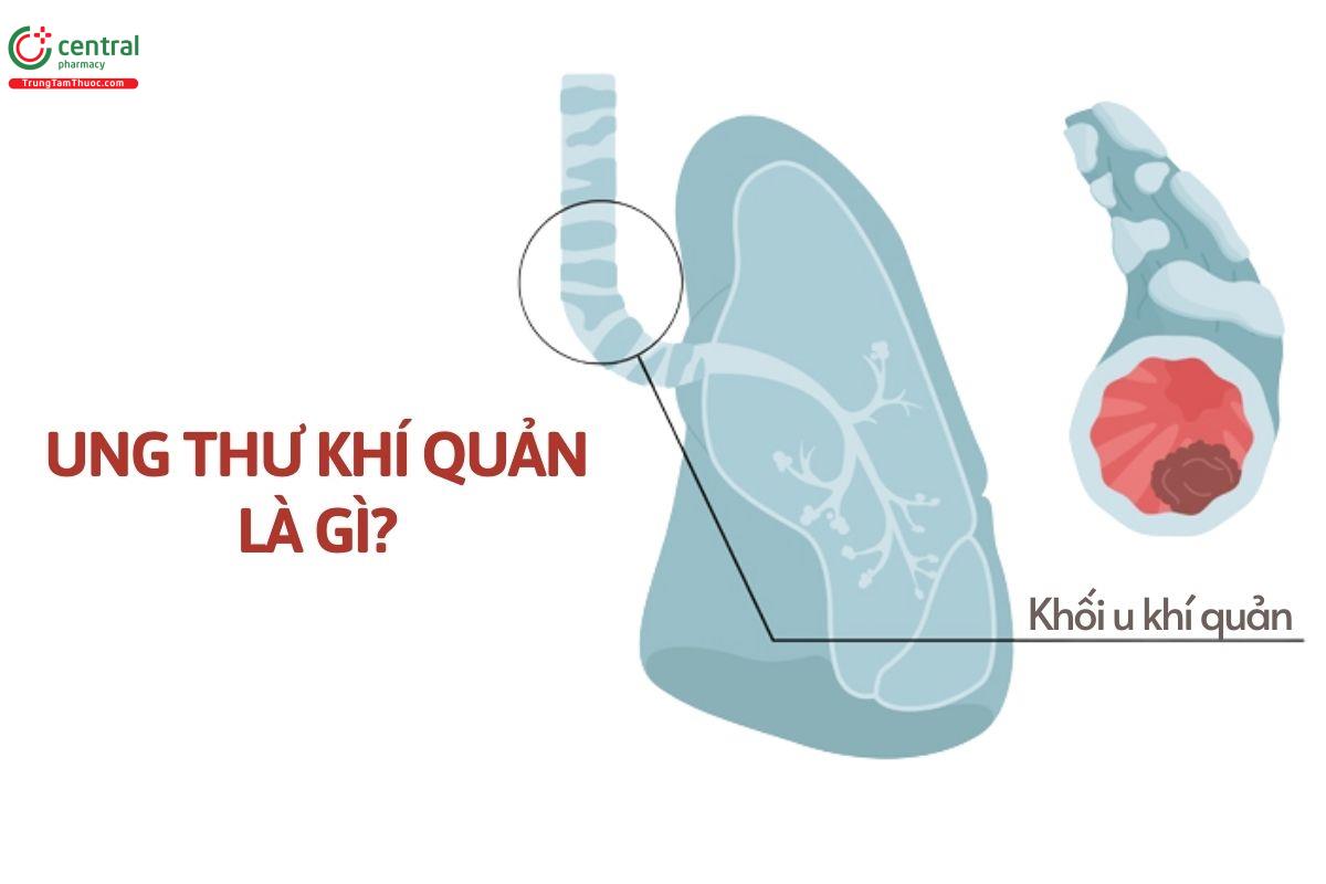 Ung thư khí quản là gì?