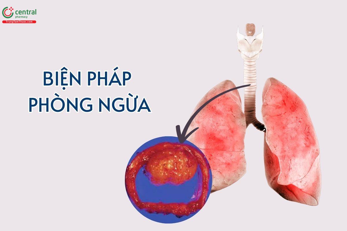 Cách phòng tránh ung thư khí quản