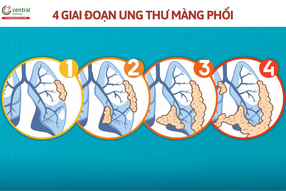 Các giai đoạn ung thư màng phổi