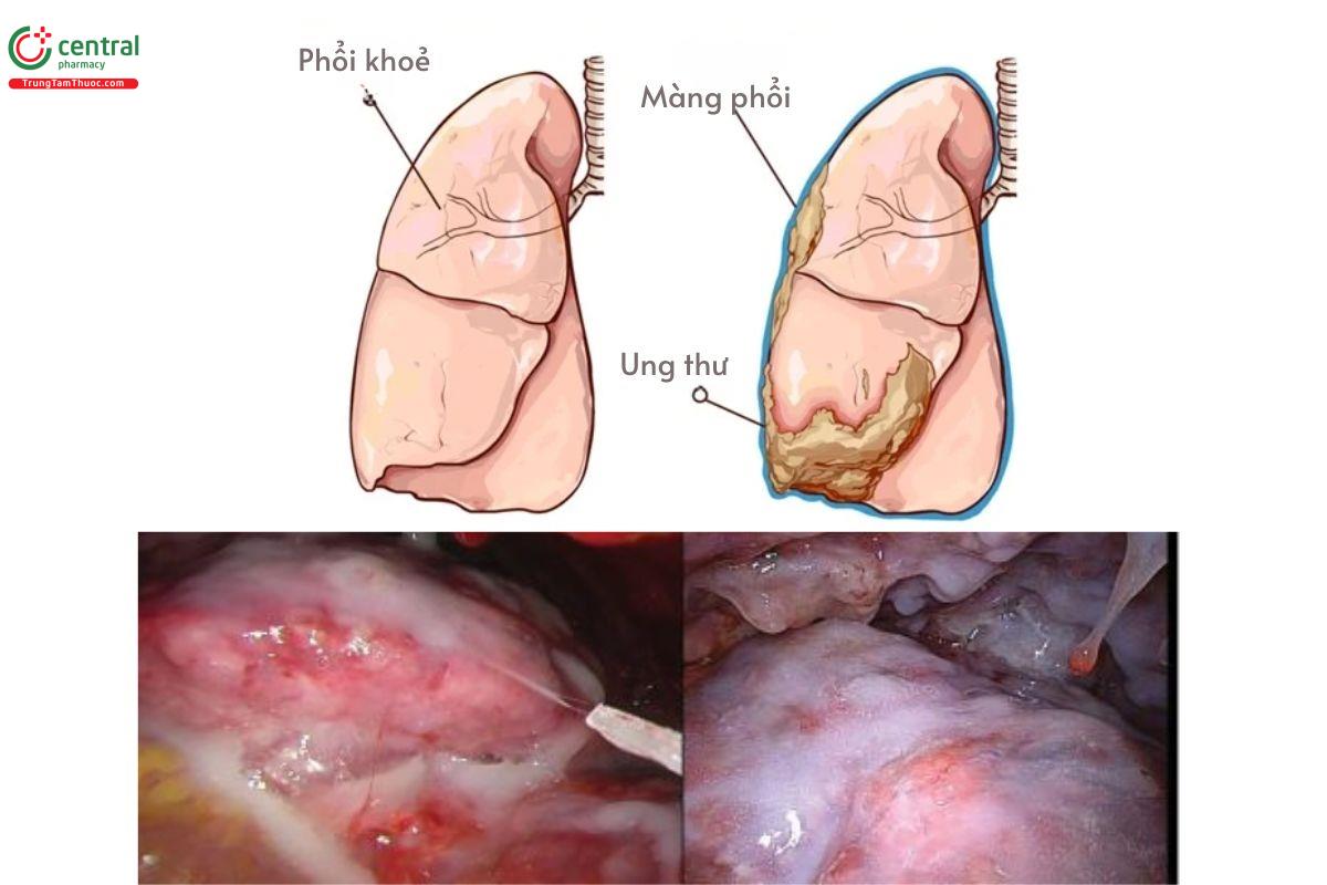 Ung thư màng phổi là gì?