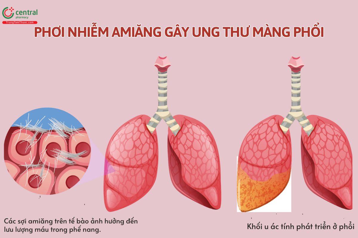 Phơi nhiễm amiăng gây ung thư màng phổi