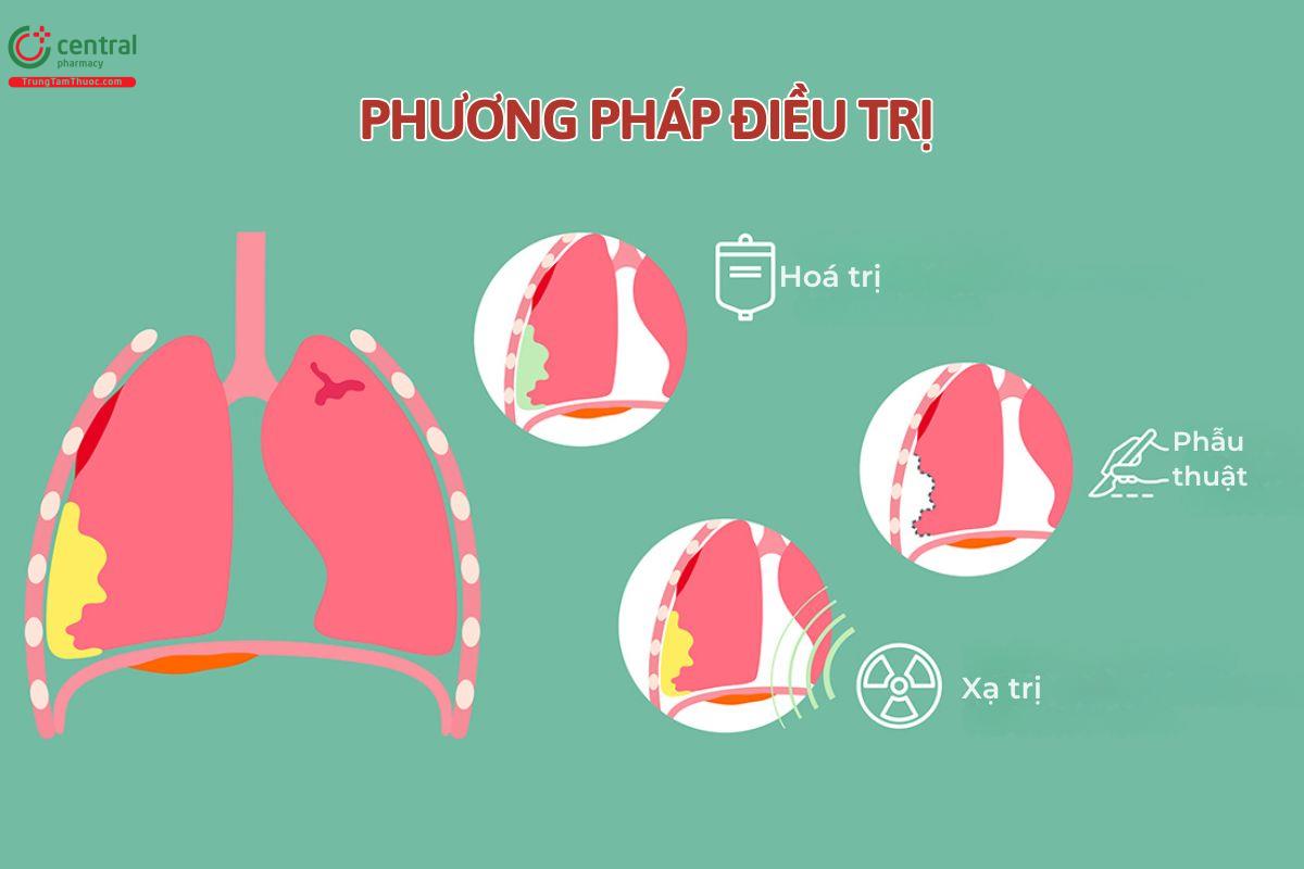 Phương pháp điều trị ung thư màng phổi