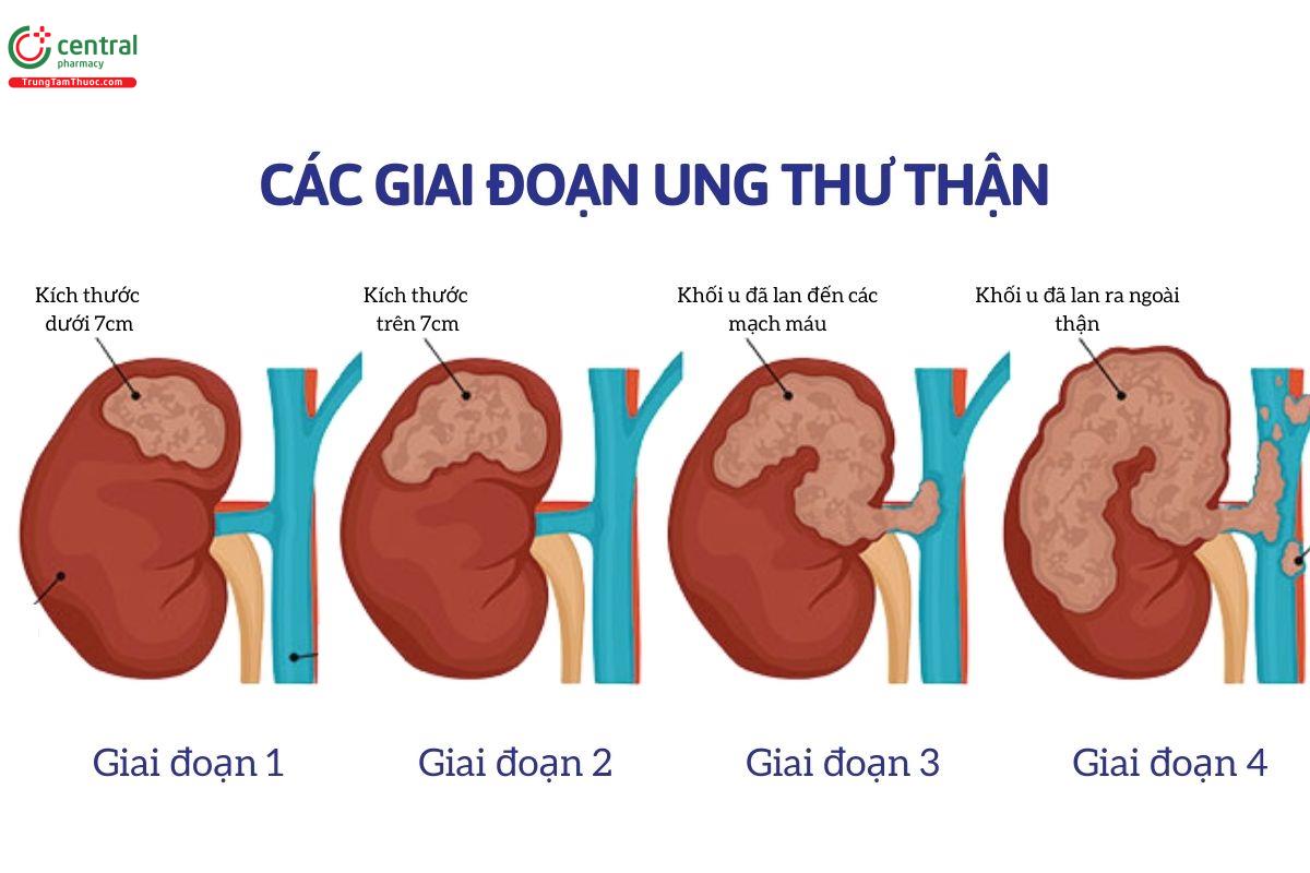 Các giai đoạn của ung thư thận 