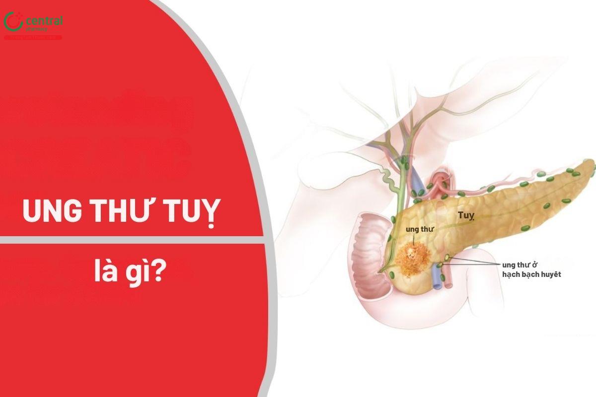 Ung thư tuyến tuỵ là gì?