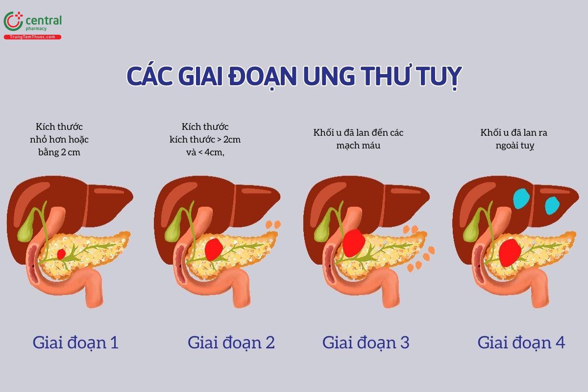 Các giai đoạn của ung thư tuỵ