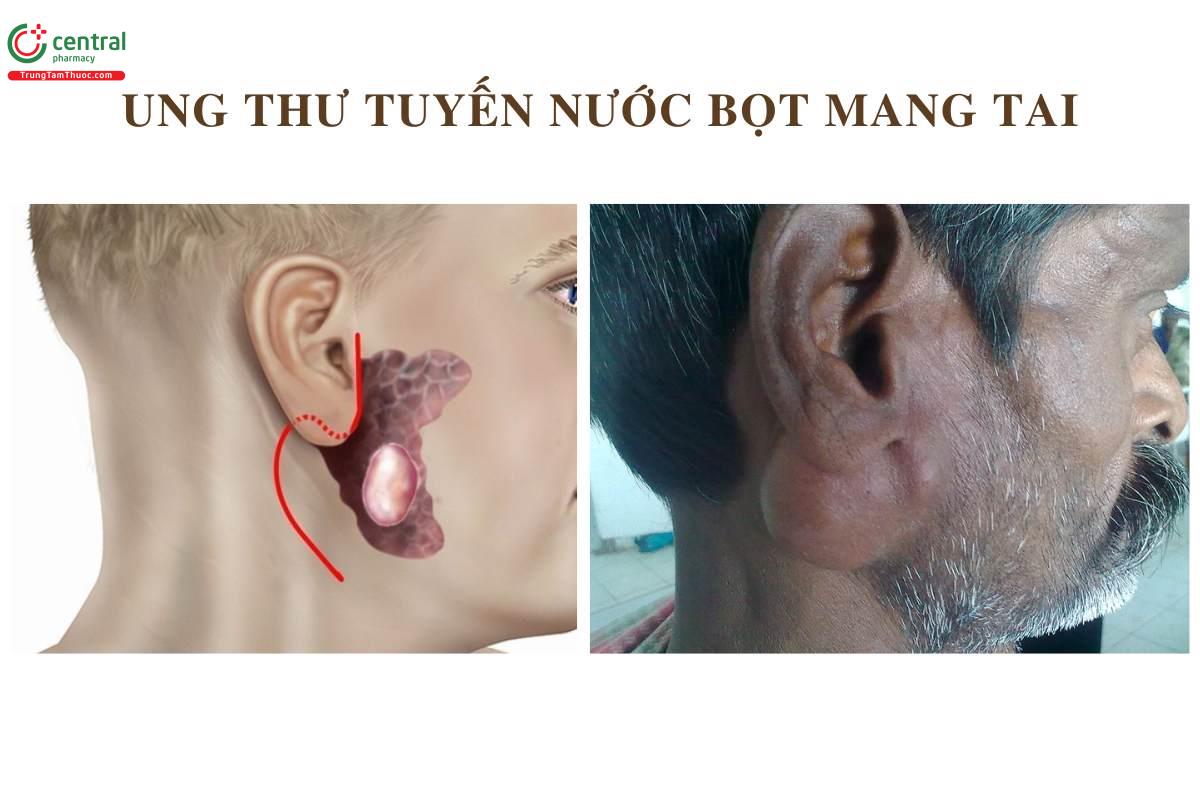 Ung thư tuyến nước bọt mang tai