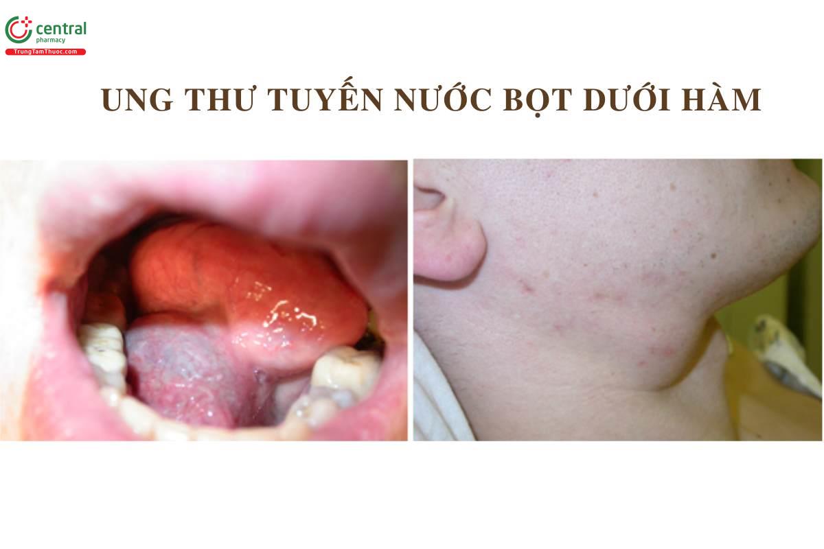 Ung thư tuyến nước bọt dưới hàm