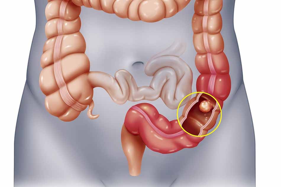Ung thư đại trực tràng giai đoạn đầu