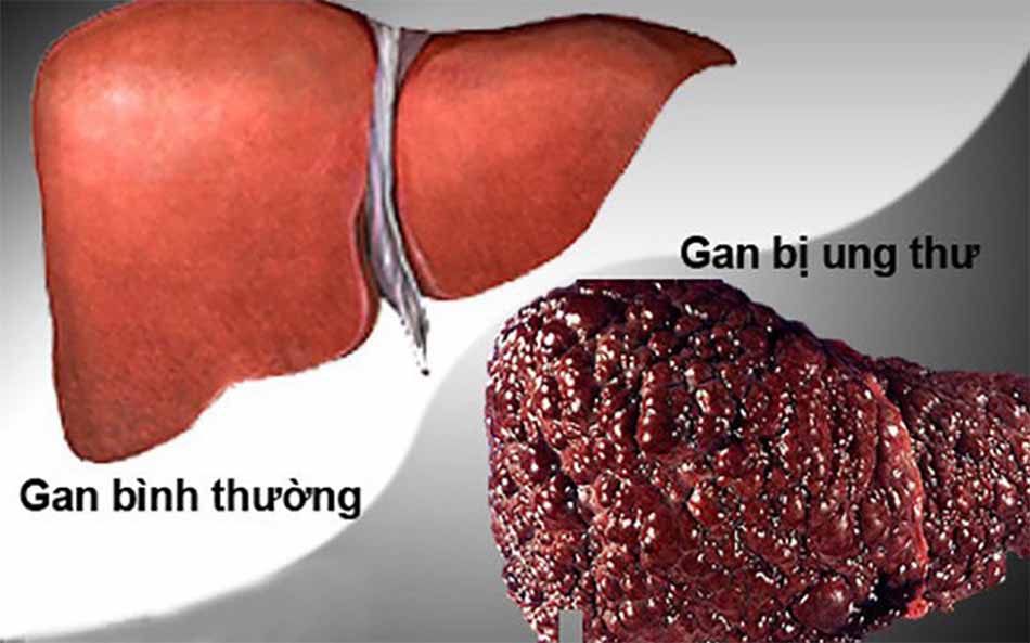 Ung thư gan
