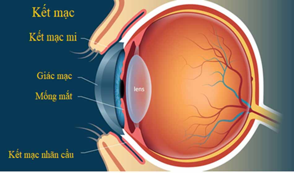 Hình ảnh kết mạc