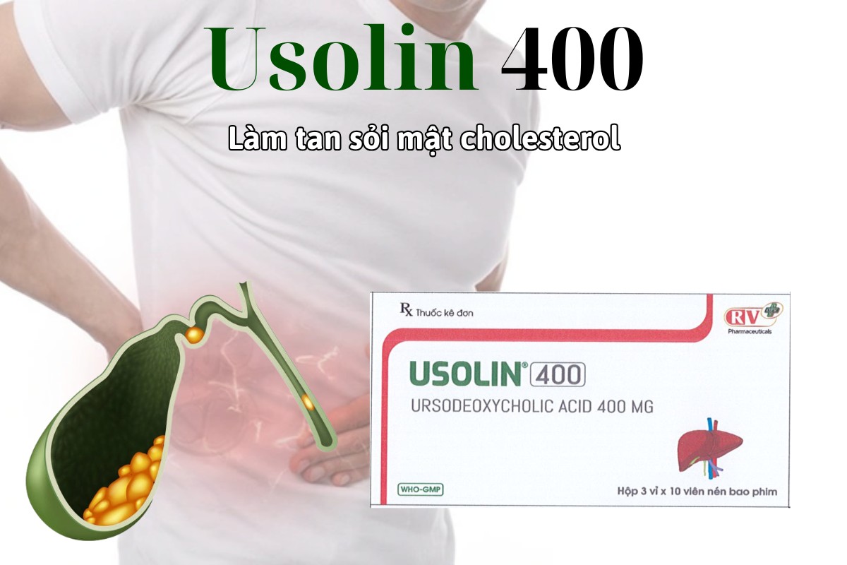 Thuốc Usolin 400 làm tan sỏi mật cholesterol không phát hiện được bằng X quang