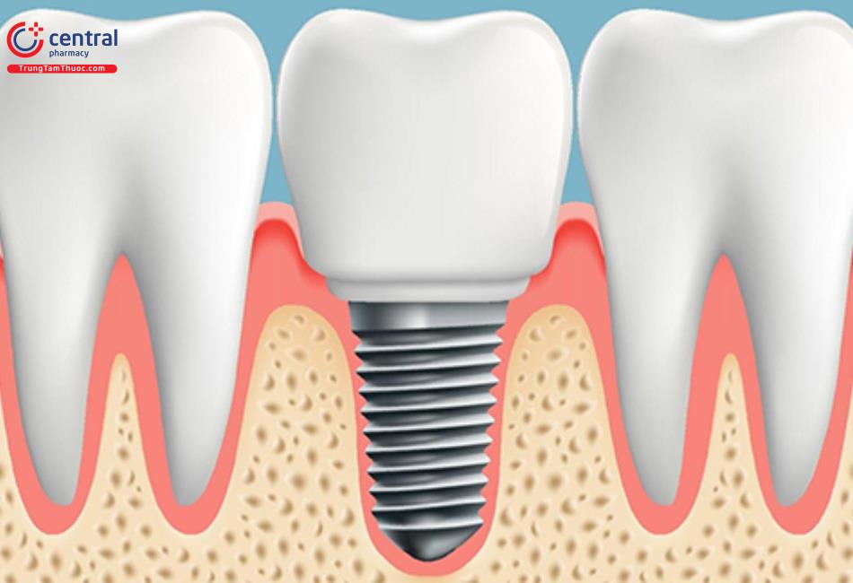Trồng răng implant có nhiêu ưu điểm vượt trội