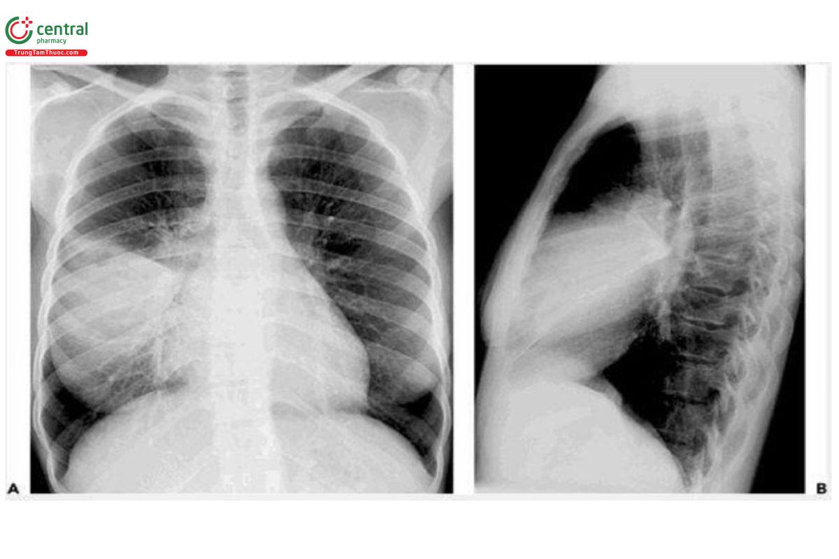 Hình 1. Hình ảnh viêm phổi thùy giữa phổi phải do Streptococcus pneumoniae (A: Phim thẳng, B: Phim nghiêng phải)