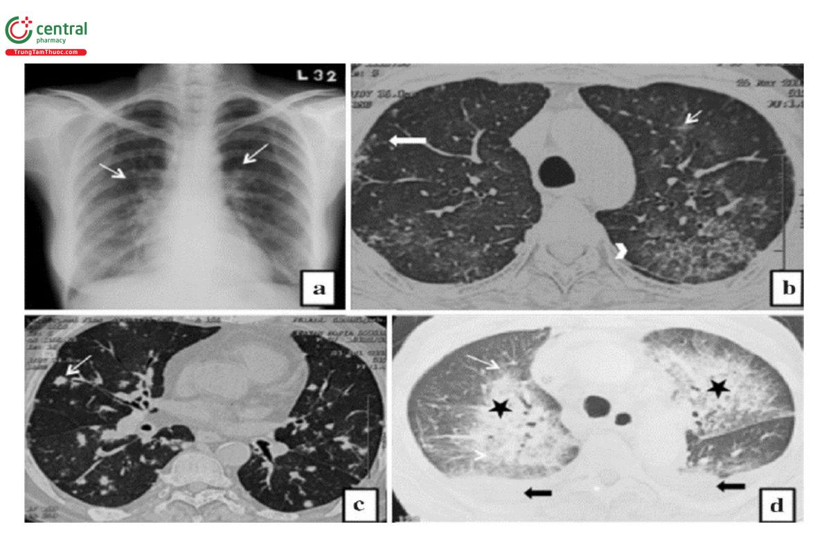 Hình 10. Hình ảnh viêm phổi do virus.