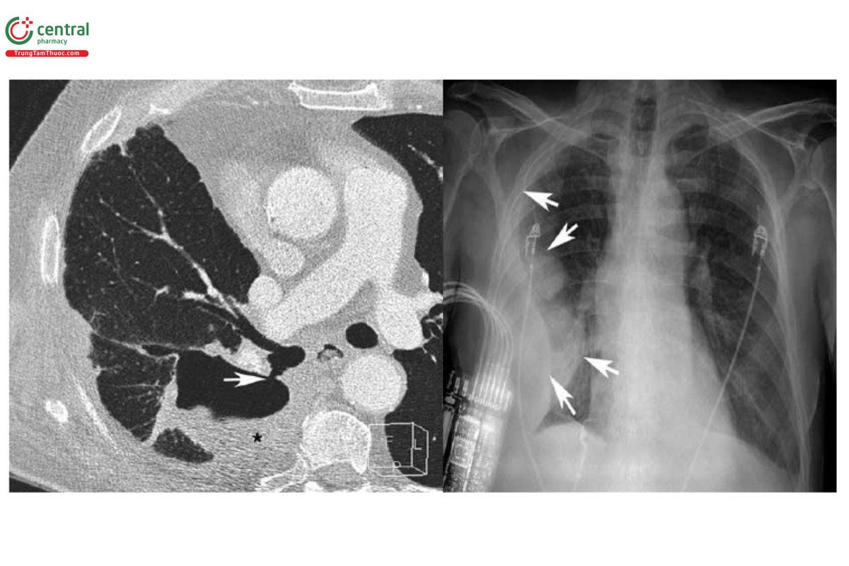 Hình 11. Hình ảnh rò phế quản - màng phổi (mũi tên), có dính nhu mô liền kề và tràn mủ màng phổi (dấu *) (ảnh trái)  và hình ảnh mủ màng phổi phải (ảnh phải)