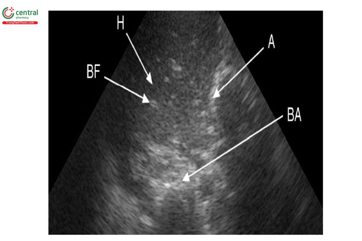 Hình 13. Hình ảnh tổn thương viêm phổi trên siêu âm.