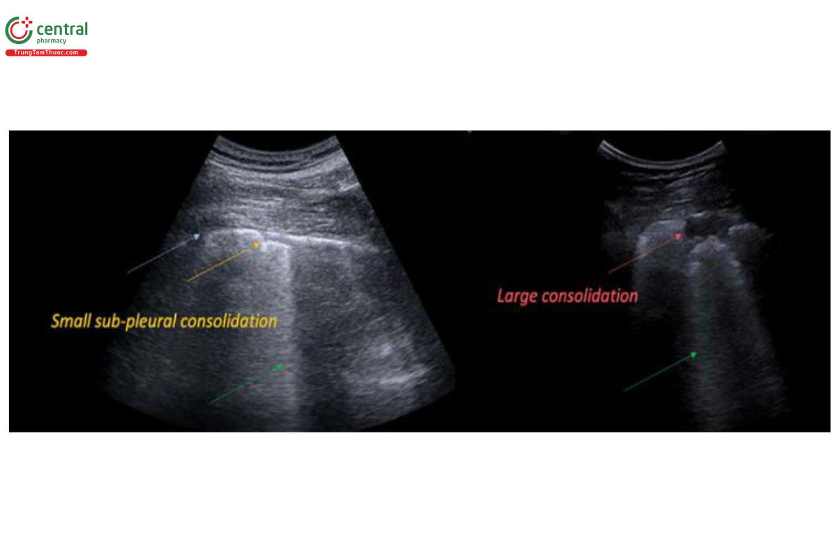 Hình 14. Hình ảnh đông đặc phổi trên siêu âm (đông đặc nhỏ dưới màng phổi: Small sub pleural consolidation; đông  đặc lớn: Large consolidation)