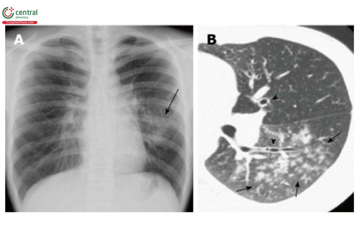 Hình 2. Hình ảnh viêm phế quản-phổi do Mycoplasma pneumoniae  A: X-quang ngực thấy các nốt, lưới mờ và đông đặc khư trú ở vùng giữa và dưới phổi trái (mũi tên). Rốn phổi trái to;  B: Trên CT thấy các nốt trung tâm tiểu thùy trên nền kính mờ ở thùy dưới phổi trái (mũi tên). Dày thành phế quản  (đầu mũi tên)