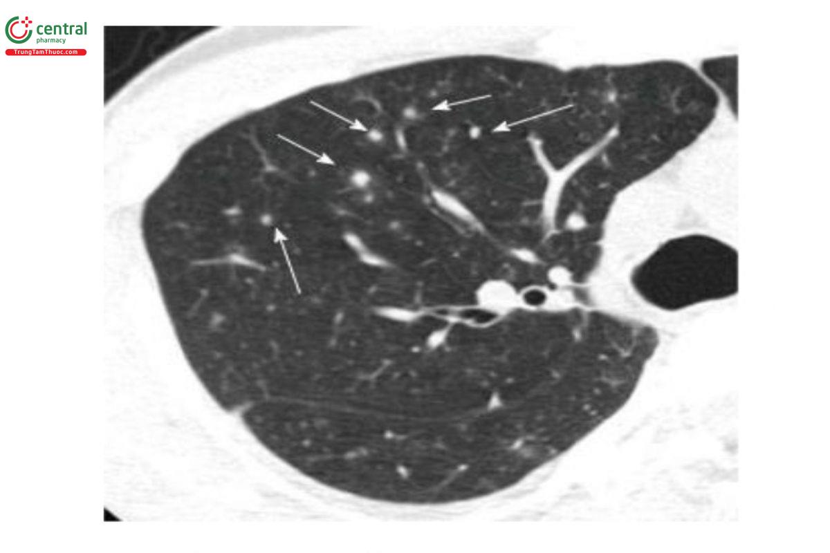 Hình 3. Hình ảnh viêm phế quản-phổi do varicella zoster