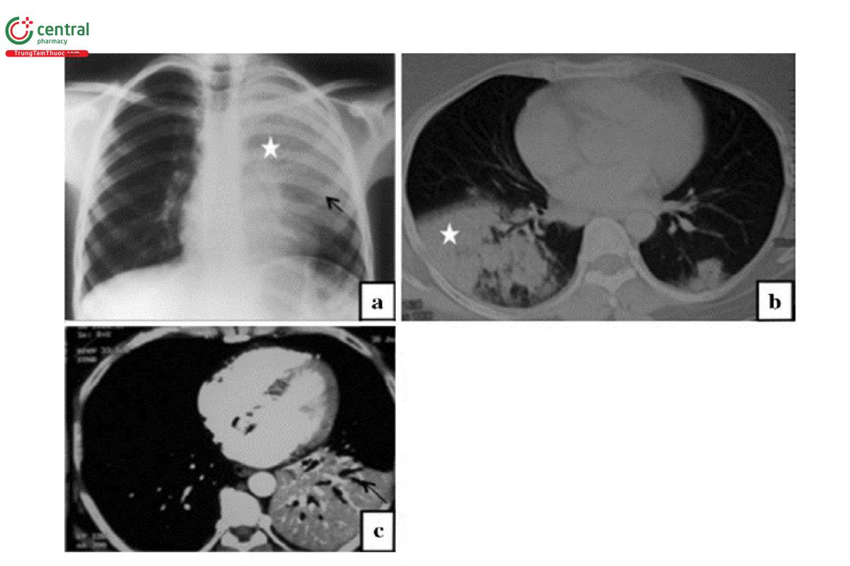 Hình 4. Hình ảnh viêm phổi thùy do liên cầu khuẩn.