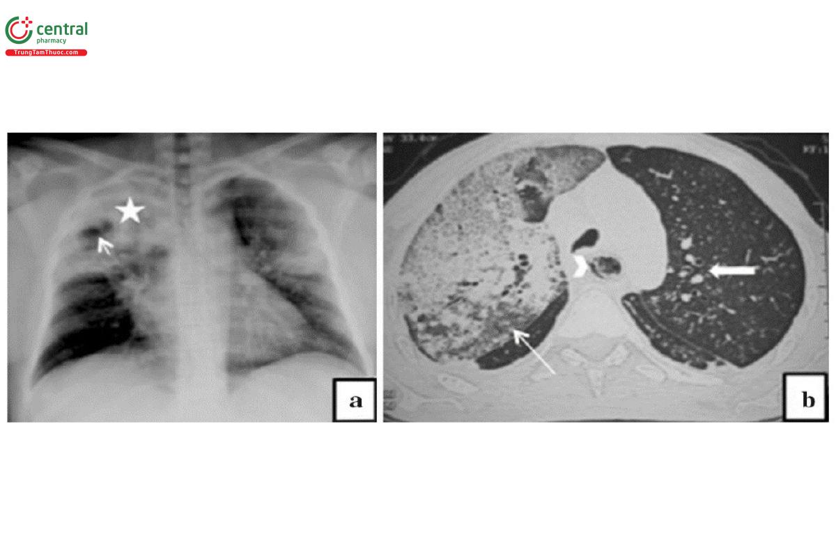 Hình 5. Hình ảnh viêm phổi do Klebsiella.