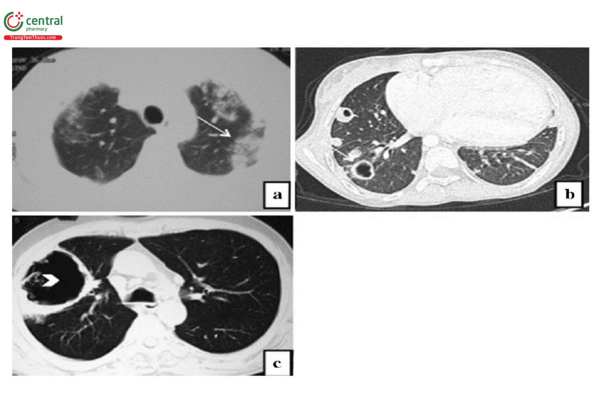 Hình 6. Hình ảnh viêm phổi do tụ cầu.