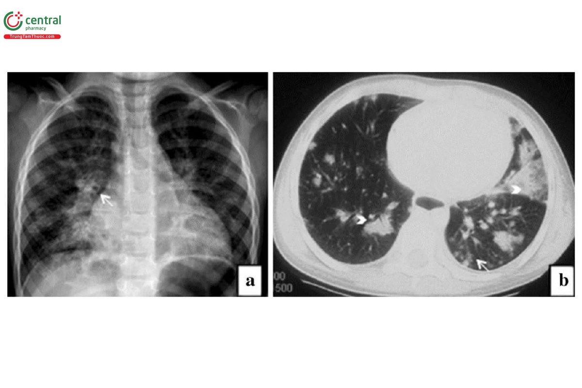Hình 7. Hình ảnh viêm phổi P. aeruginosa.
