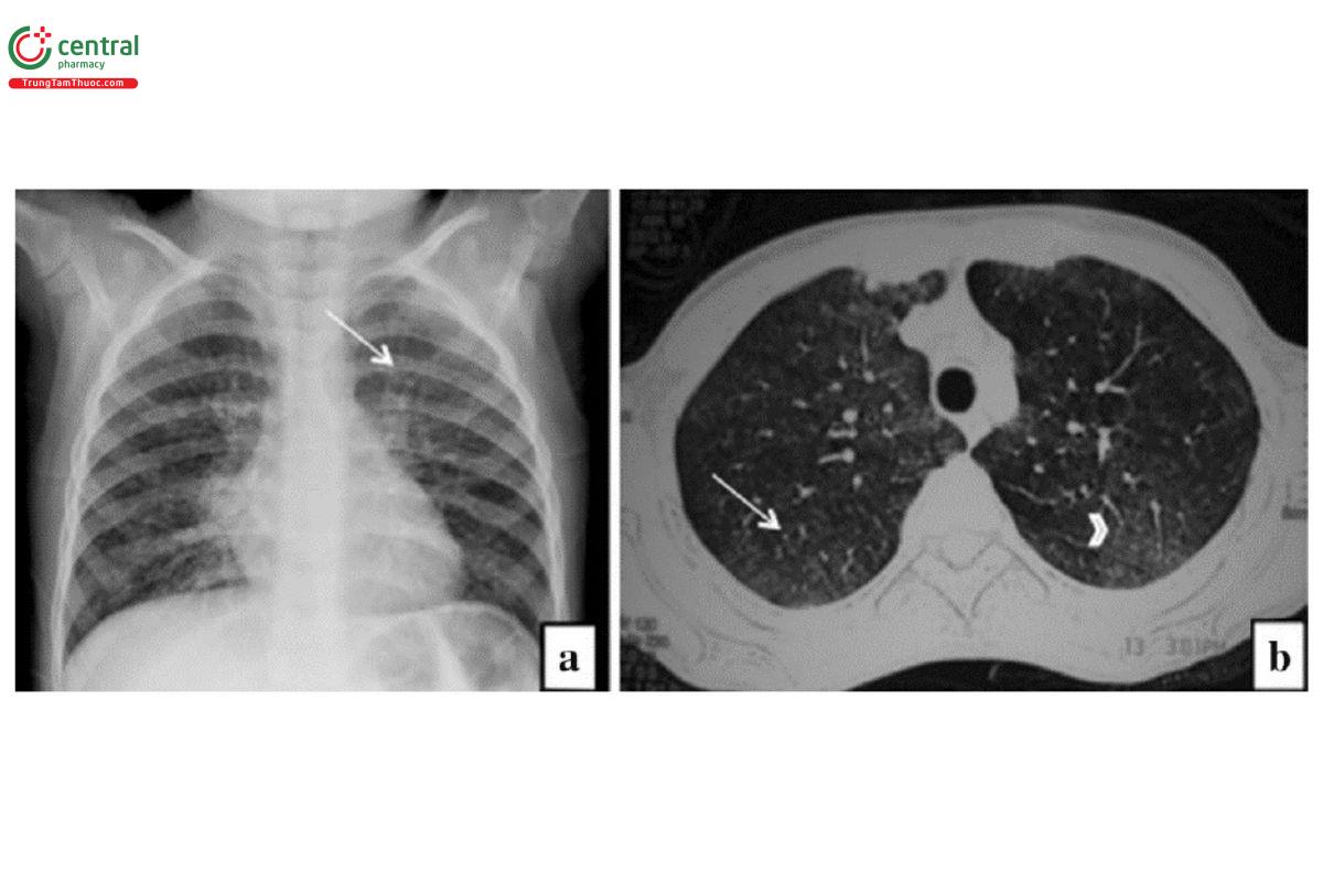 Hình 8. Hình ảnh viêm phổi do Mycoplasma.