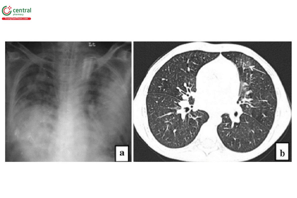 Hình 9. Hình ảnh viêm phổi do Legionella (hình ảnh đông đặc thùy và từng đám ở cả hai phổi - hình a) và hình ảnh  viêm phổi do Mycoplasma (hình ảnh GGO từng mảng ở thùy lưỡi - mũi tên trắng, hình b)