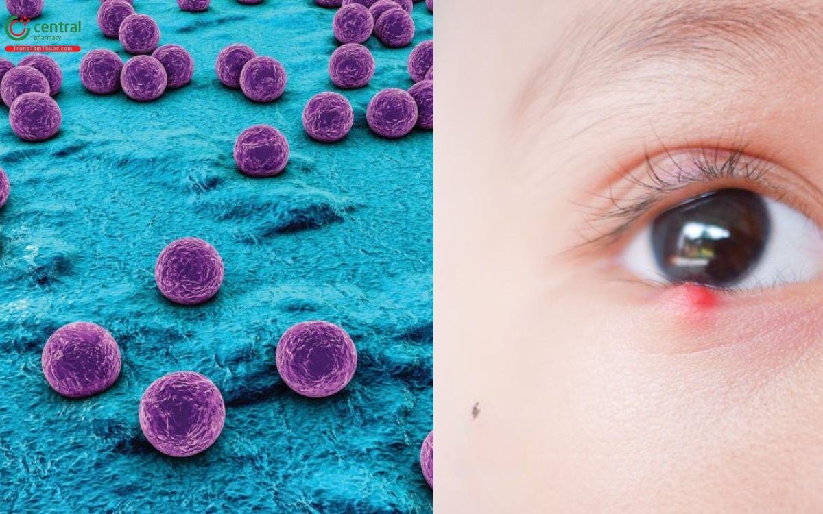  Tụ cầu Staphylococcus nguyên nhân chính gây lẹo mắt
