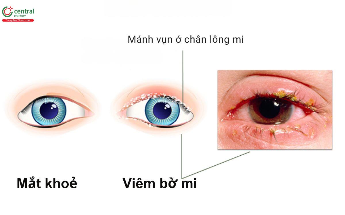 Bệnh viêm bờ mi mắt