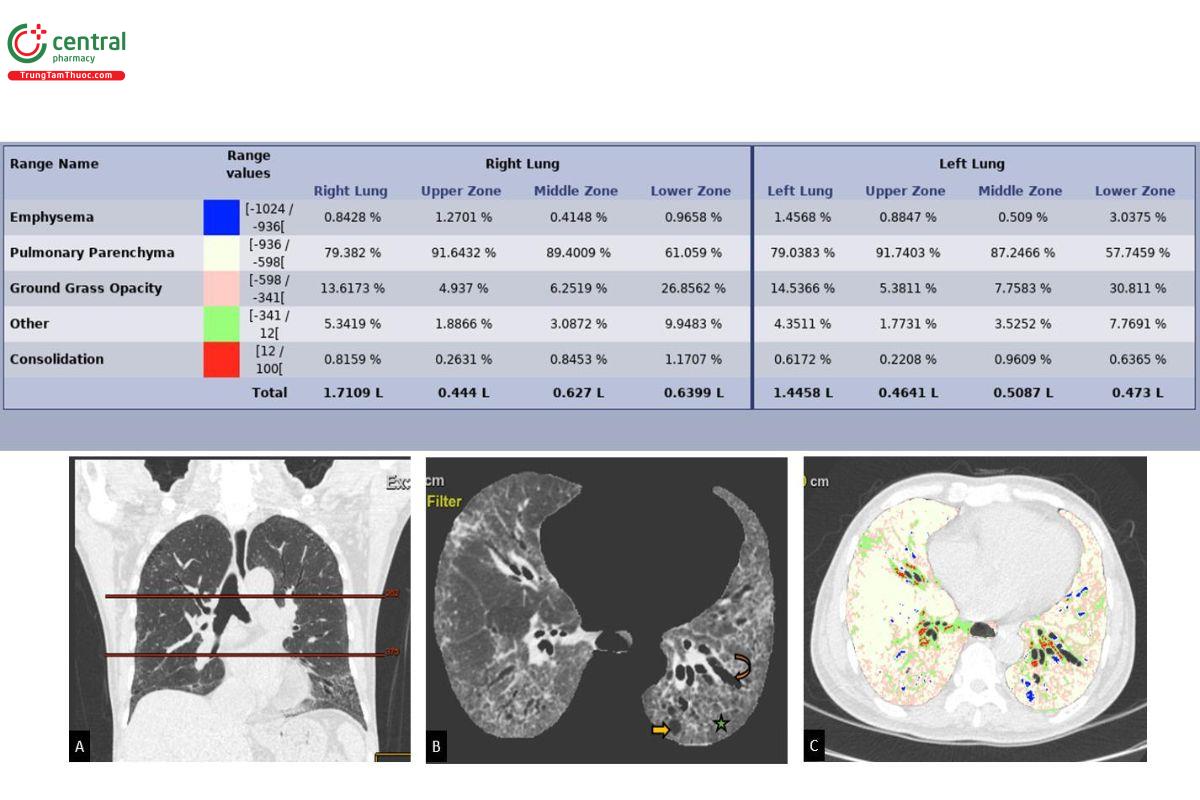 Hình 4. Bảng định lượng tổn thương phổi ở bệnh nhân bị ILD kiểu hình NSIP xơ hóa bằng ứng dụng Thoracic VCAR  GE Healthcare. A: Các phân vùng phổi được giới hạn bởi mặt phẳng ngang qua bờ dưới cung động mạch chủ ngực  và bờ dưới tĩnh mạch phổi phải (Hiroto, Lancet Respir Med, 2020,[3]). B: các hình ảnh kén khí dưới màng phổi (mũi  tên thẳng), dãn phế quản (mũi tên cong), hình lưới (dấu sao). C: Hình ảnh phân vùng thương tổn nhu mô, gồm: Màu  vàng: nhu mô phổi bình thường; Màu hồng: vùng kính mờ; Màu xanh lá: tổn thương xơ; Màu đỏ: các mạch máu; Màu  xanh dương: khoảng khí.