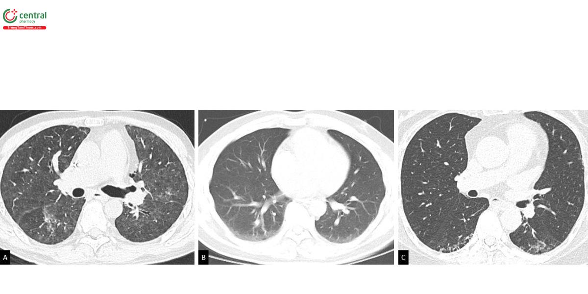 Hình 1. Các ví dụ phân loại bất thường phổi kẽ (ILAs). A. Tổn thương kính mờ và lưới không phân bố ưu thế dưới  màng phổi. B. Tổn thương kính mờ phân bố dưới màng phổi không xơ hoá (còn tồn tại trên phim chụp nằm xấp). C.  Tổn thương kén khí dưới màng phổi (không bao gồm khí thũng).