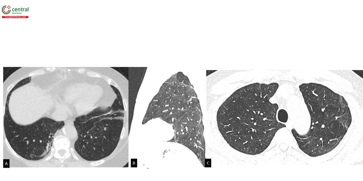 Hình 2. Tổn thương hậu COVID-19. A: Các dải xơ xẹp. B: Tổn thương tưới máu thể khảm. C: Tổn thương quanh  phân thùy phổi.