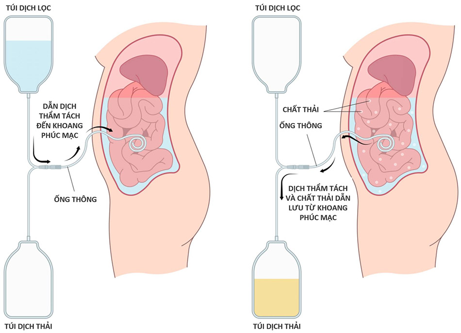 Lọc màng bụng liên tục ngoại trú (viết tắt là CAPD)