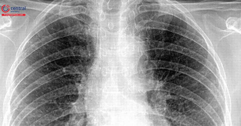 Chụp X-quang phổi