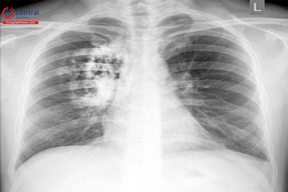 Hình ảnh X-quang phổi