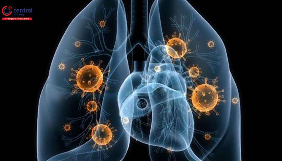 Vi khuẩn không điển hình gây viêm phổi ở trẻ.