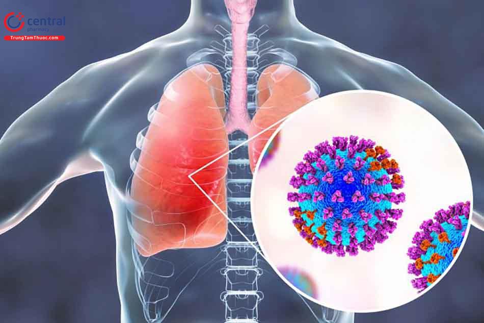 Bệnh viêm phổi mắc phải ở cộng đồng