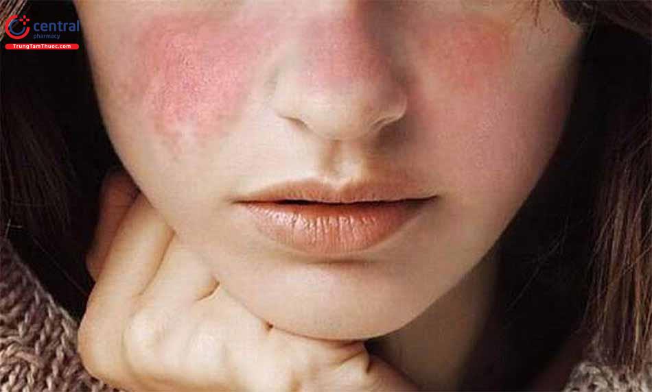 Hình ảnh lupus ban đỏ