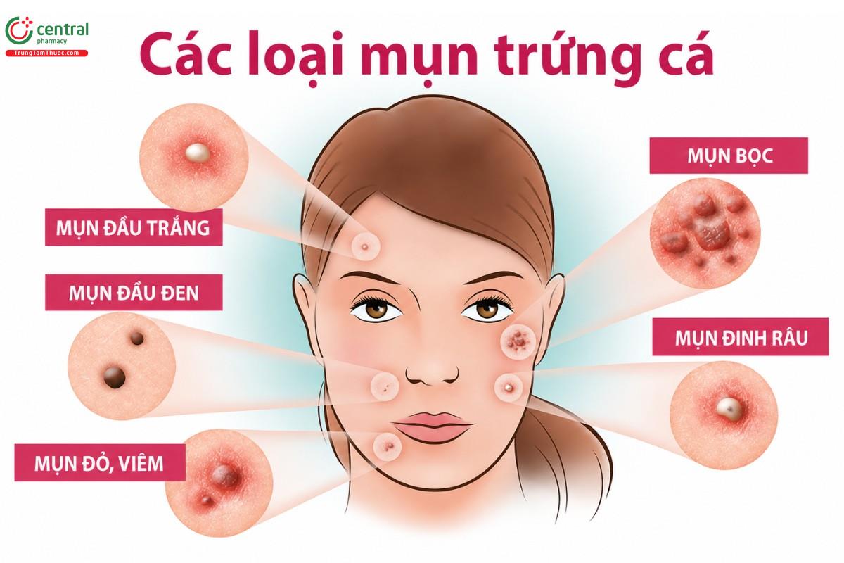 Các loại mụn trứng cá