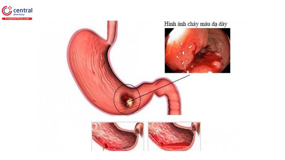 Xuất huyết tiêu hóa do loét dạ dày tá tràng