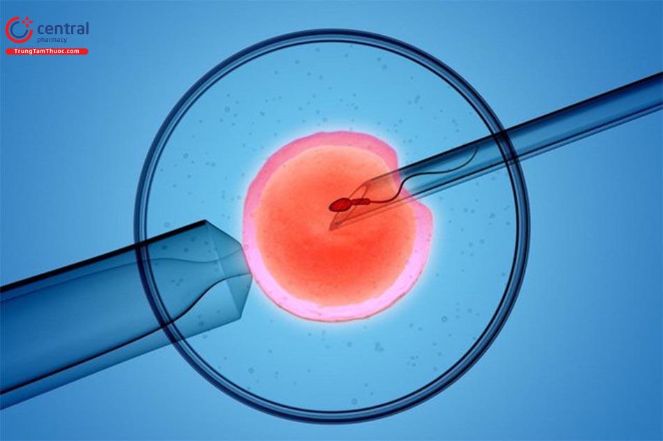 Phương pháp thụ tinh nhân tạo từ tinh trùng trong nước tiểu của người bệnh xuất tinh ngược