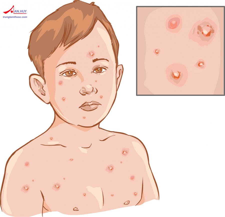 Bệnh thủy đậu: Cách thức lây lan, chẩn đoán, điều trị và dự phòng