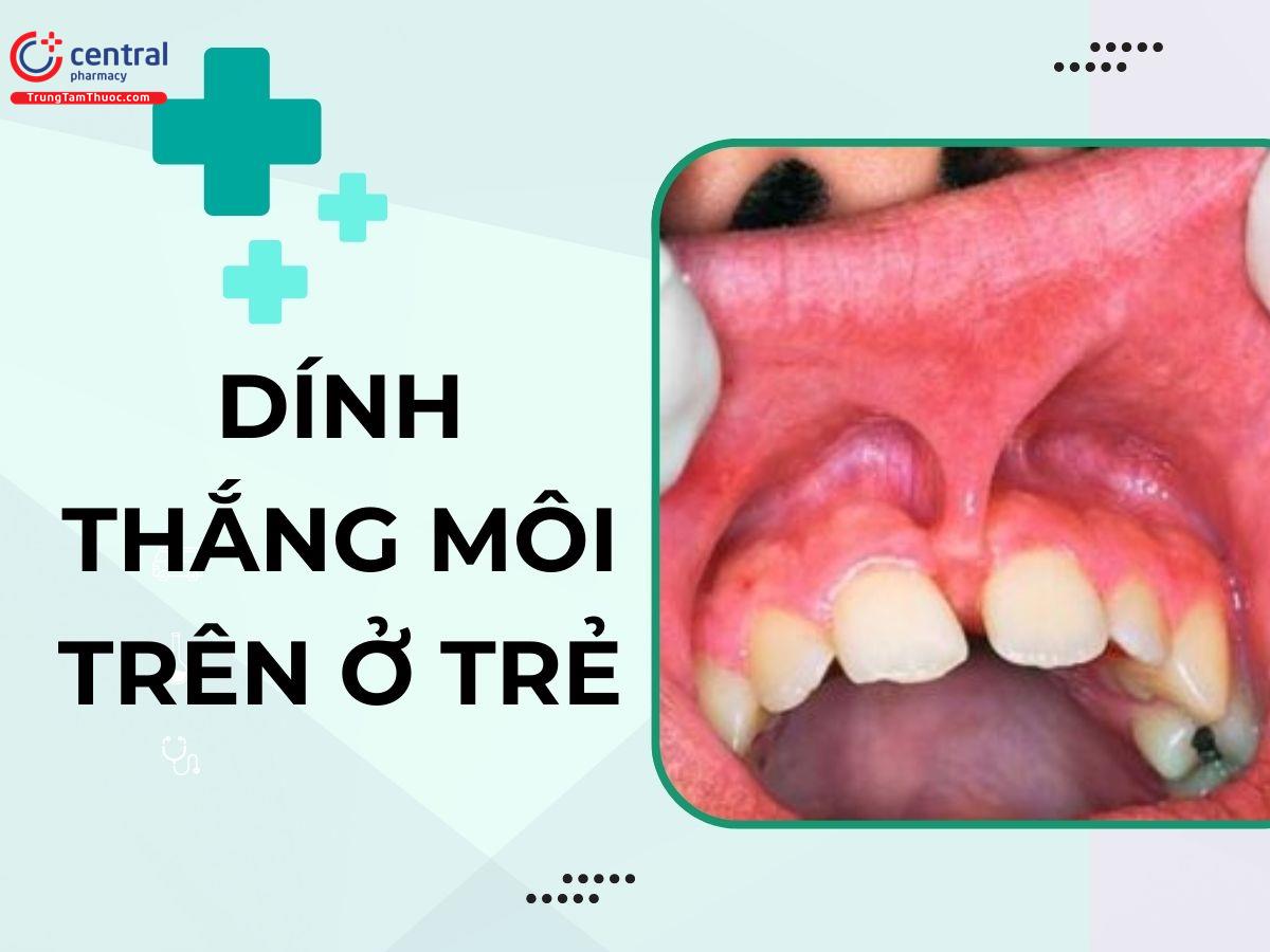 Trẻ bị dính thắng môi trên có sao không? Biểu hiện của dính thắng môi trên