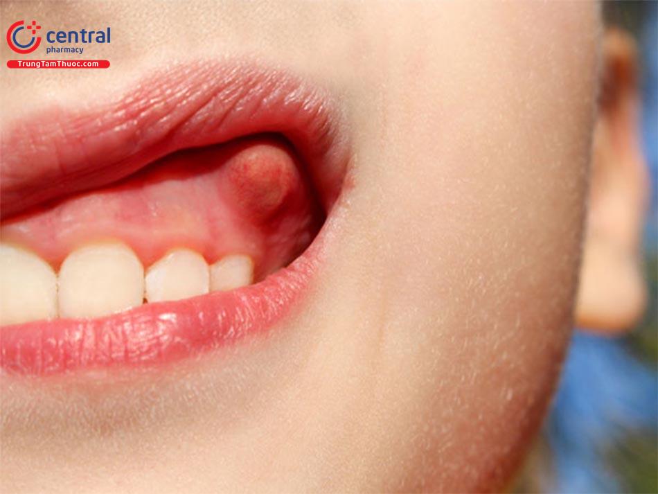 Áp xe răng: nguyên nhân, điều trị và phòng ngừa bệnh
