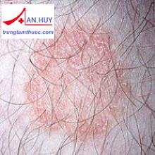 Bệnh nấm da do Dermatophytes: triệu chứng và điều trị