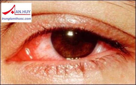 Bệnh viêm kết mạc do nhiễm virus: triệu chứng và điều trị