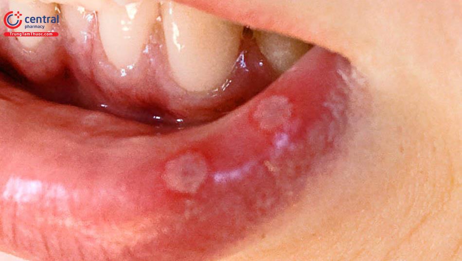 Bệnh Aphtose (nhiệt miệng): triệu chứng và cách điều trị