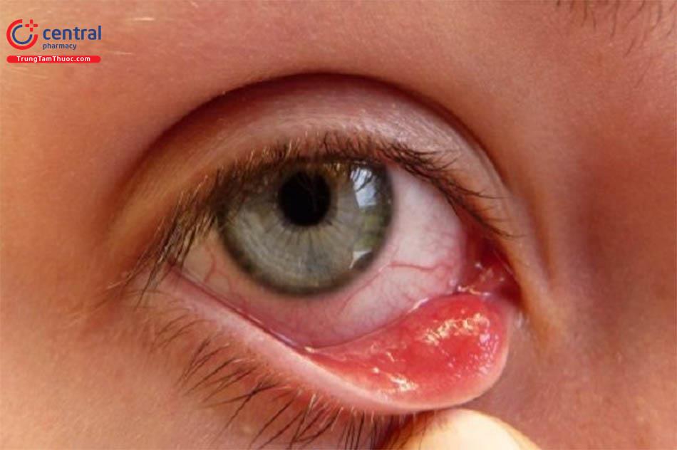 Bệnh đau mắt hột: triệu chứng và cách điều trị   